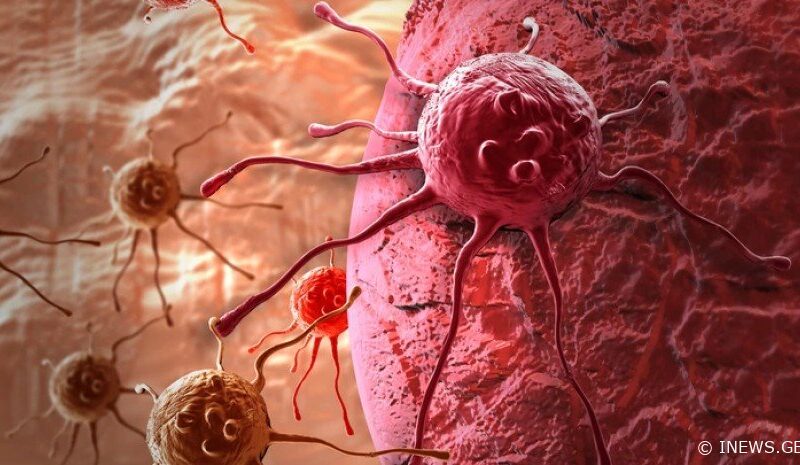 მეცნიერებმა ქალებში “ჩუმი” კიბოს მოულოდნელი სიმპტომი დაასახელეს